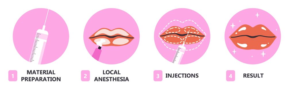 Lip filler infographic. Data visualization and tutorials. Botox injections and facelifting, plastic surgery. Beauty, elegance and aesthetics. Flat vector illustration isolated on white background