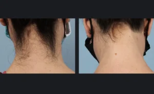 gentle hair removal back of neck