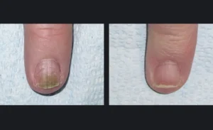 gentle nail fungus removal